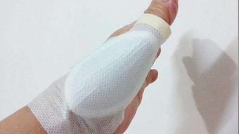 腱鞘炎封闭视频,腱鞘炎封闭治疗操作步骤详解